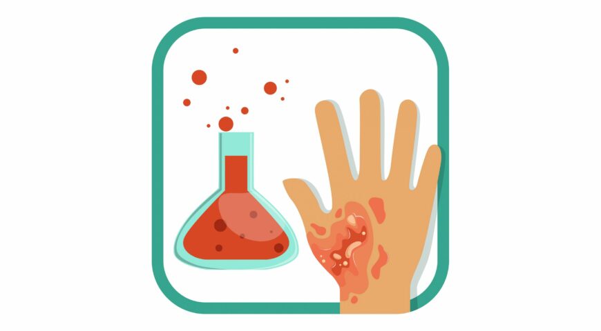 How to treat a chemical burn