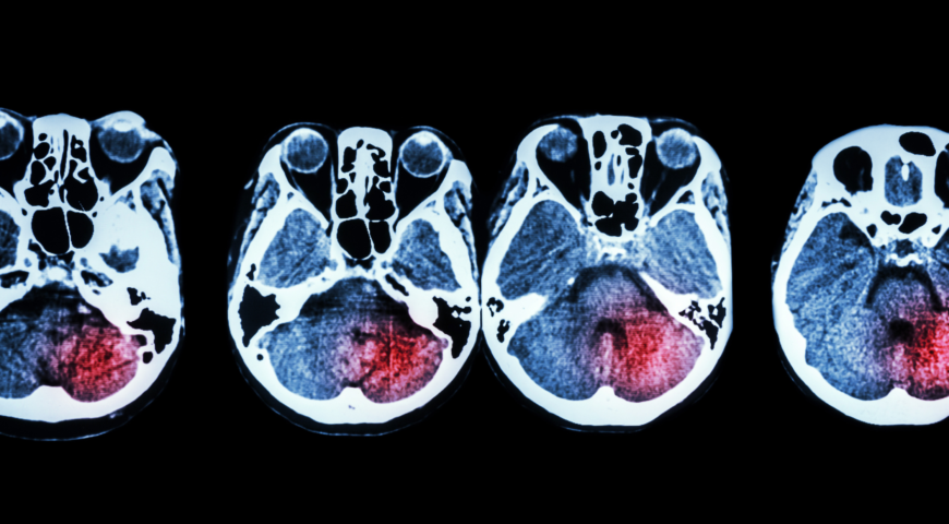 Stroke awareness: Symptoms you can’t ignore